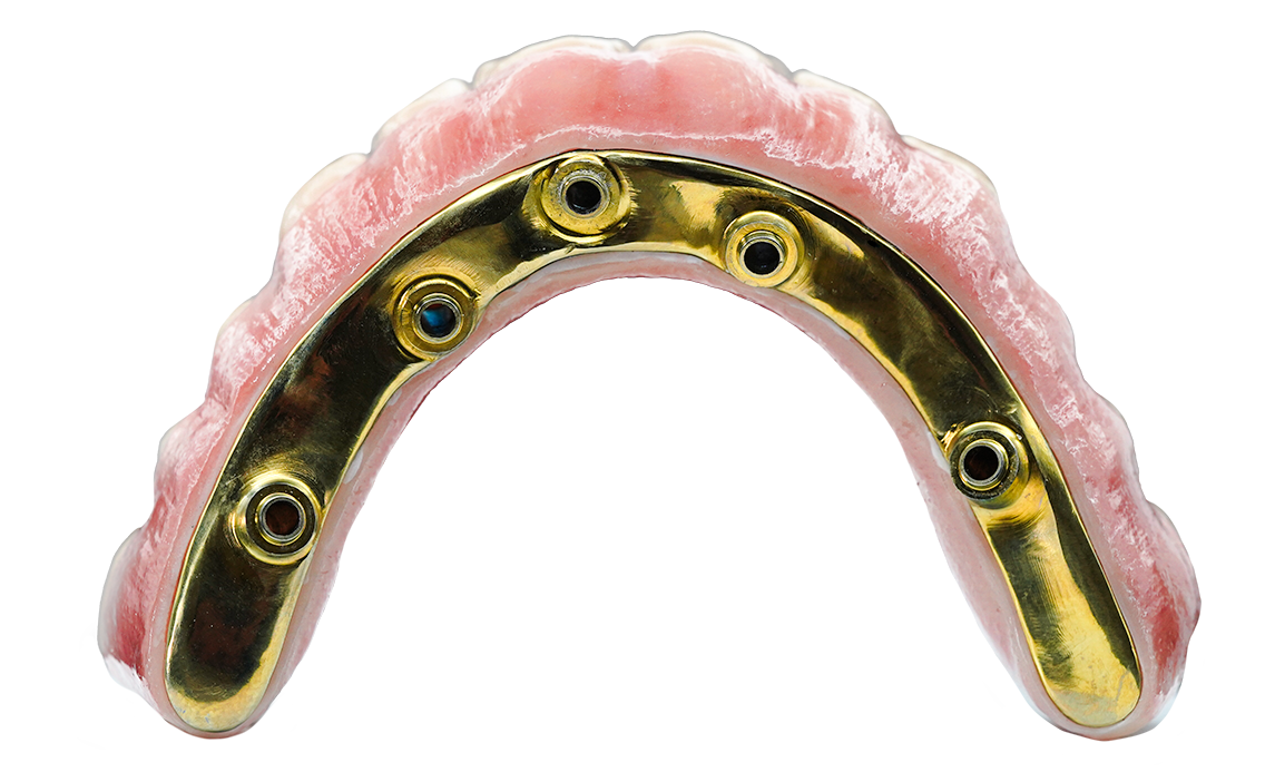 TLZ-IB with Metal Substructure